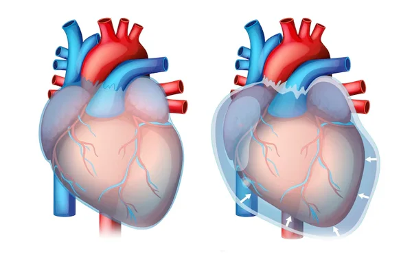 TAVI And TAVR