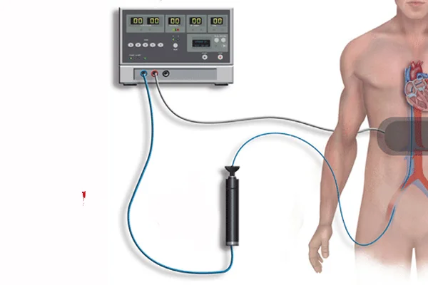 Radiofrequency Ablation