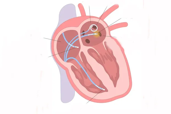 Electrophysiology Study