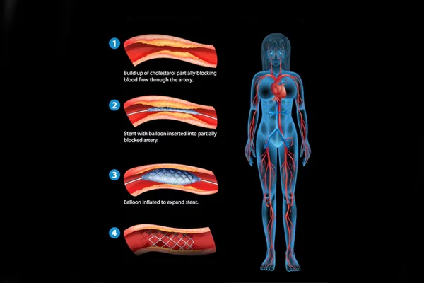 PDA Stenting